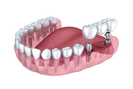 Dental Implants Portland OR