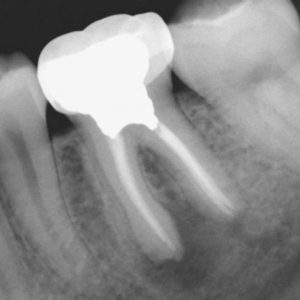 Root Canal Portland