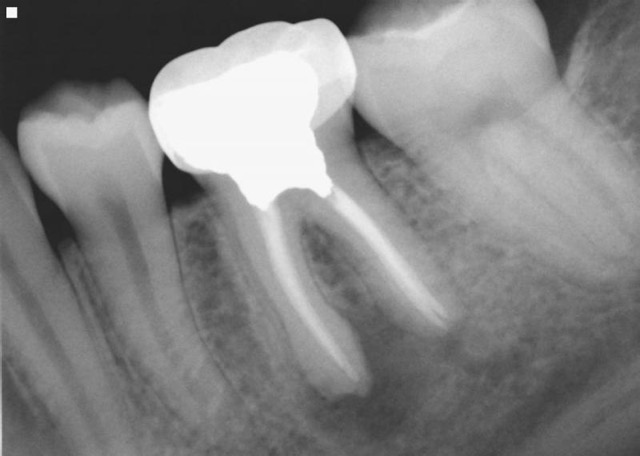 Root Canal Portland