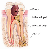 Root Canal Portland OR