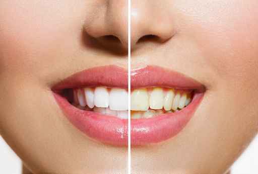 Teeth Whitening Portland OR